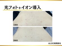 アルゴ 堺東駅前店(ALGO)/光フォト＋イオン導入