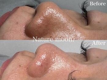 ナチュールムーン(Nature moon.)/毛穴洗浄