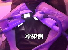 サニー(SUNNIE)/脂肪冷却装着例