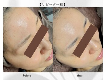 アン ビューティー(ann beauty)/リピーター様【症例写真】30代