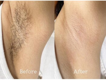 プアマヌ(PUA MANU)/脇脱毛でお洒落を楽しむ♪