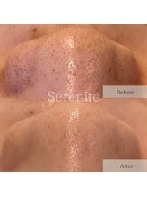 セレニテ(Serenite)/症例写真