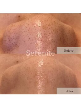 セレニテ(Serenite)/症例写真