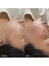 アイリー(IRIE)/肌が綺麗になるフェイスワックス