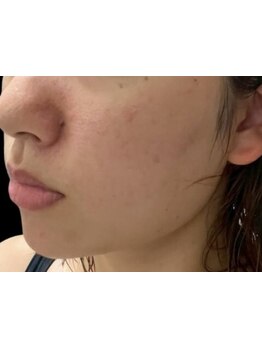 毛穴ケアをしたい