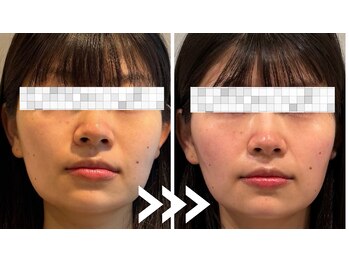 ミトノウ(MITONOU)/エアセラム ビフォーアフター