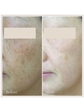 ベルタ(BELTA)/ケア前→7ヶ月後　シミ/雀卵斑