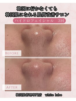 ホワイトラボ 梅田(White labo)/【施術例】ハイドロフェイシャル
