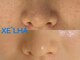 ビビ(BIBI)の写真/【SNSで超話題★】韓国ピーリング×HBLとのセットがお得に受けられる♪