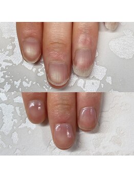 自爪矯正/地爪矯正/二枚爪/深爪