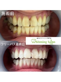 ホワイトニングサロン 札幌店/【ホワイトニング】#札幌#大通り