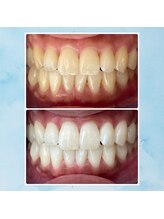 エンコロレ(encolore)/《クリスタルホワイトニング》