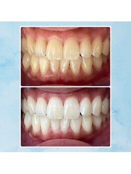 エンコロレ(encolore)/《クリスタルホワイトニング》