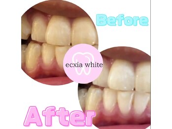 エクシアホワイト 広島袋町店/ホワイトニングビフォーアフター