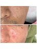 男性ニキビ肌荒れケア　カウンセリングのみ　【肌荒れ、肌質改善】当日施術OK