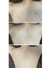 リコ(Lico)/背中ニキビケア