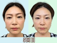 ナチュラルパーフェクトフェイス 新宿/5回目／新宿駅近小顔矯正