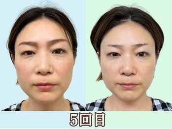 ナチュラルパーフェクトフェイス 新宿/5回目／新宿駅近小顔矯正