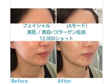 わたしの。三島店/フェイシャルマシン1万2千S