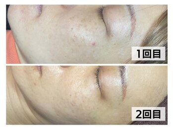 モテ美白/超人気コース!