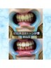 圧倒的人気【プレミアムセルフホワイトニング】カウンセリング