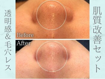 ネオファースト(NeoFirst)/1度で透明感アップ&毛穴レス