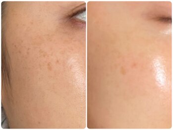 イデアルミー 大宮店(イデアルMe)/ララピールBefore 7回目Afteｒ