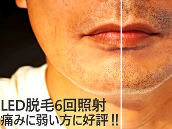 ドクターリバース(Dr.Reverse)/メンズ脱毛/ひげ脱毛/LED脱毛6回