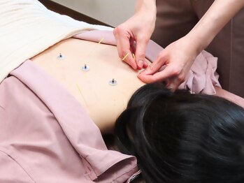 コハル鍼灸整骨院 本郷三丁目(COHARU鍼灸整骨院)/施術風景☆全身鍼灸・体質改善