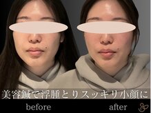 チョコバリ 恵比寿店(chocobari)/小顔リフトアップ（美容鍼）20代