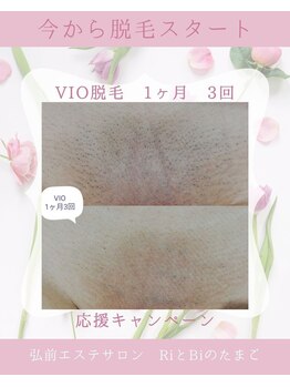 RiとBiのたまごの写真/早い効果を実感するVIO脱毛！夏までにツル肌へ導く、弘前で選ばれるサロン◎　今すぐご体験を！