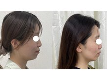 ワイサロン(Y salon)/【小顔症例】コルギ／4回目