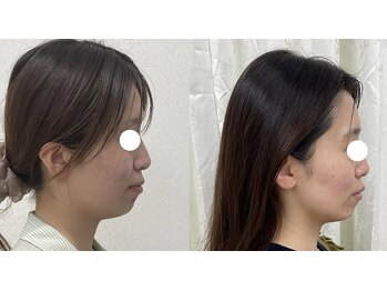 ワイサロン(Y salon)/【小顔症例】コルギ／4回目