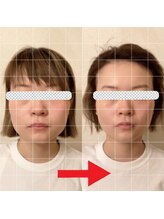 グロッシー(glossy)/小顔矯正