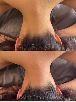 レーヌ(Reine)/うなじえりあし脱毛