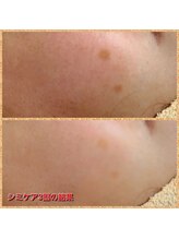 脱毛サロン アンジェ 浦安店/シミケアでお悩み解消！