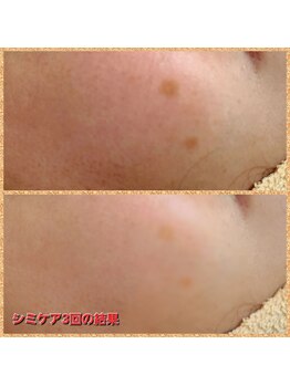 脱毛サロン アンジェ 浦安店/シミケアでお悩み解消！