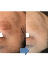 レベンディス(LEVENDIS)/シミケア特化ハーブピーリング