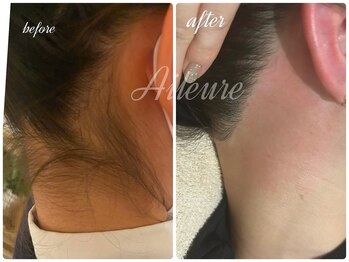 エルール トータルビューティ(Aileure total beauty)/うなじ美人　うなじ脱毛