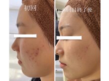 ヒジ(Life Salon)/お顔ハーブピーリング