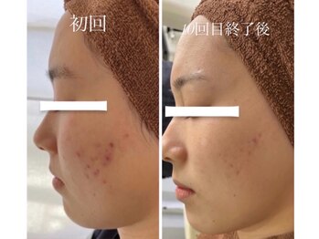 ヒジ(Life Salon)/お顔ハーブピーリング