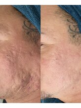 ソリッジ肌管理室/ニキビケア