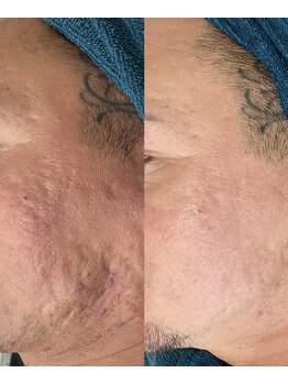 ソリッジ肌管理室/ニキビケア