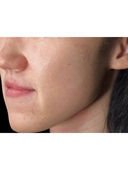 美白ケアをしたい