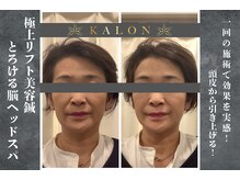 カロン(KALON)の雰囲気（たるみ、ほうれい線を美容鍼とヘッドスパで頭皮からリフトアップ）
