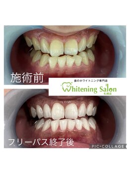 ホワイトニングサロン 札幌店/【ホワイトニング】#札幌#大通り