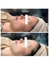 メロウゴールド(Mellow Gold)/ウィンバック×ハーブピーリング