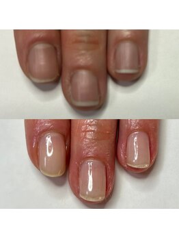 マニュコクーン(ManuCocoon)/爪育成 深爪 巻き爪 大阪市