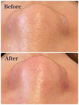 毛穴専科/毛穴の黒ずみをしっかり除去!