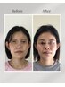 【5名限定】実績1万件！美容鍼を極めたプロの技術で小顔・ほうれい線ケア1回